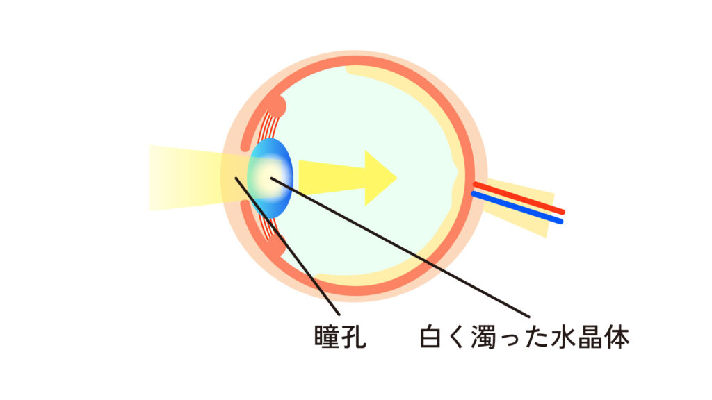 【東京・池袋】白内障の原因・症状・治療方法・費用・手術 | 【池袋の眼科-松原クリニック】・白内障手術の名医